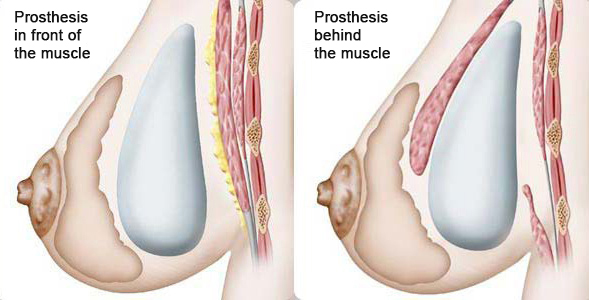 breast implants abroad